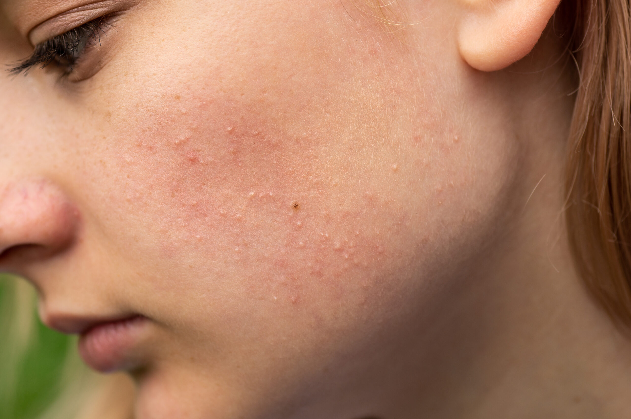 Glacons sur les boutons : bonne ou mauvaise idée ?